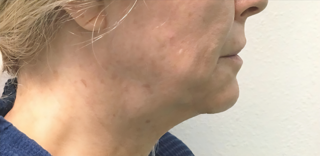 Lipo de papada Antes